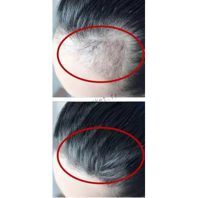 Sérum traitement capillaire cheveux Anti-perte de cheveux repousse cheveux 2x30ML3