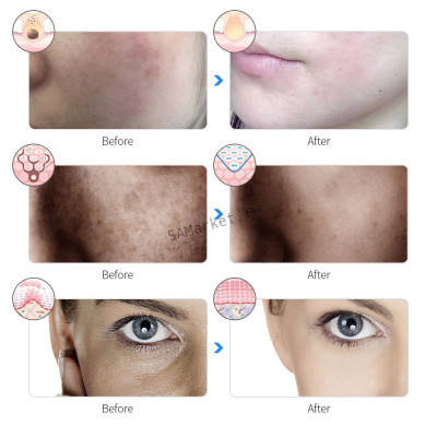 Masque électronique de lifting visage avec 7 mode de photothérapie photons rajeunissement de la peau anti-acné suppression des rides masque de soins pour la peau éclaircissant6